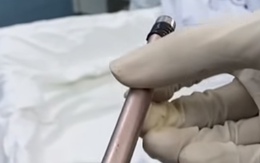 Thiếu nữ 16 tuổi phải cấp cứu ban đêm vì có cây bút trong bàng quang