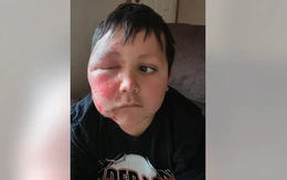 Bé trai bỏng nặng vì làm theo trào lưu TikTok cho đồ chơi vào lò vi sóng