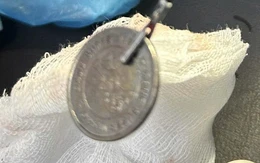 Cận Tết liên tiếp xử trí ca trẻ nuốt dị vật, có trẻ nuốt cả đồng xu