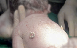 Em bé sinh ra với ‘đôi cánh nhỏ’ trên lưng