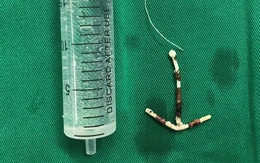 Lấy vòng tránh thai lạc chỗ suốt 1/4 thế kỷ