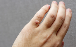 Bệnh hạt cơm lây như thế nào và nguy hiểm ra sao?