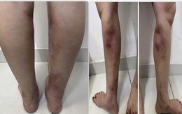 Chân biến dạng sau tiêm filler làm thẳng chân tại nhà