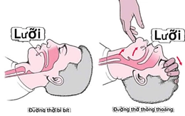 Đừng kéo lưỡi khi cấp cứu 'nuốt lưỡi'