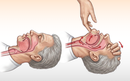 Đừng kéo lưỡi khi cấp cứu 'nuốt lưỡi'