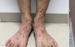 Bọ chét chó, mèo ‘tấn công’ người, gây ngứa ngáy, viêm da vì điều trị sai cách