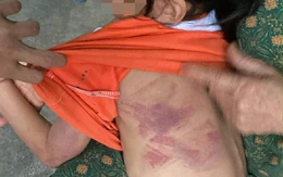 Bé gái lớp 2 bị bạn đánh bầm tím người trong giờ ra chơi