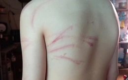 Phụ huynh tố con đi học thêm bị thầy đánh bầm tím, thầy giáo nói gì?