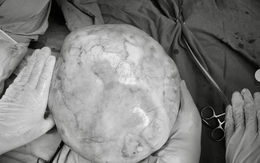 Hy hữu bé gái 14 tuổi mang khối u nặng hơn 4kg có răng, tóc, xương