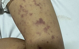 Viêm não mô cầu, 1 trẻ không qua khỏi