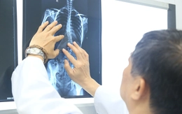 Nhiều trẻ vẹo cột sống nặng mới đi khám, chuyên gia cảnh báo nguy cơ biến chứng nặng