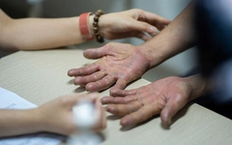 Vừa nắng nóng đầu mùa, bệnh da liễu đã bùng phát: Làm gì để phòng tránh?