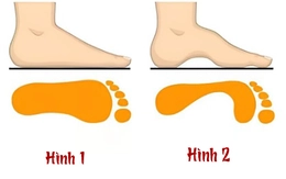 Quiz: Hình dạng vòm bàn chân tiết lộ gì về con người bạn?