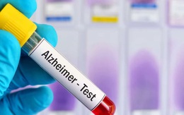 Bộ xét nghiệm máu mới giúp phát hiện sớm bệnh Alzheimer