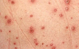 Vắc xin có từ lâu, vì sao ca nhập viện do thủy đậu vẫn tăng?