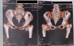 Bé gái 12 tuổi mắc hội chứng người hóa đá cực hiếm
