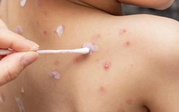 Cần xóa bỏ lầm tưởng ‘thủy đậu là bệnh nhẹ, dễ lành’