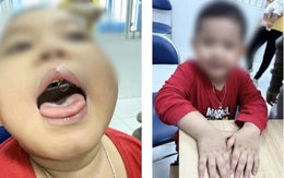 Ngưng thở khi ngủ kéo dài, bé trai tím tái cả khi thức suốt 2 năm