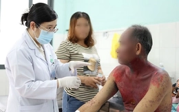 Người đàn ông bị hoại tử thượng bì nhiễm độc nặng sau dùng thuốc nhỏ mắt