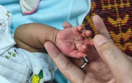 Trẻ 2 tháng tuổi mắc giang mai bẩm sinh, dễ nhầm bệnh ngoài da