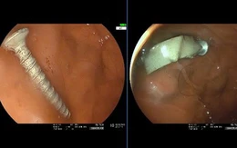 Cứu bé gái 11 tháng tuổi nuốt phải đinh vít dài 4cm