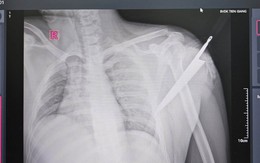 Cấp cứu thành công cho nam thanh niên bị dao cắm sâu vào bả vai