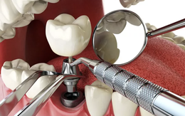 Người bệnh đái tháo đường có nên cấy implant ngay sau khi nhổ răng?