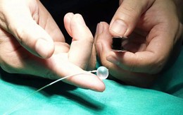 Lần đầu tiên tại Việt Nam: Đặt bóng vào khí quản thai nhi 30 tuần tuổi, cứu trẻ từ trong bụng mẹ