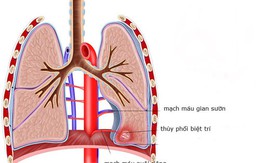 Cắt bỏ phần phổi dư ở trẻ 4 tuổi