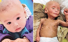 Bé trai lão hóa và chết sau khi tiêm vắc xin