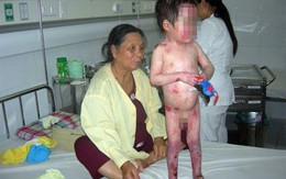Những vết phỏng nước hiểm nghèo