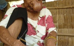 Người mang nhiều khối u