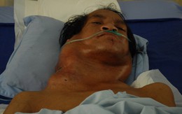 Bướu "lạ" phát triển nhanh