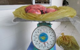 Lấy khối u nặng 7kg ra khỏi cụ bà 78 tuổi