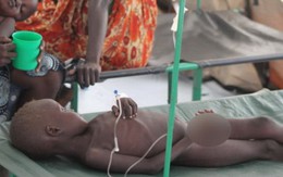 Bùng phát dịch tả ở Nam Sudan, hơn 60 người chết
