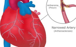 Blog bác sĩ: Bạn có bệnh tim không?