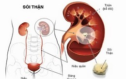 Cảnh giác với bệnh sỏi thận