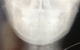 ​Bé trai bị cọng sắt đâm xuyên cổ