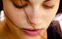 ​Rối loạn nội tiết gây nám da