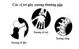 ​Loãng xương - Nguyên nhân và hậu quả khó lường