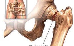 ​Loãng xương và những con số báo động