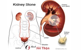 ​Trị sỏi thận đúng cách không cần phẫu thuật