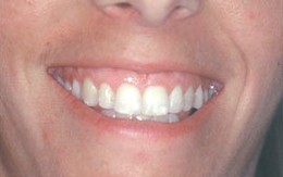 Nhiều phương pháp điều trị cười hở lợi