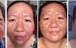 Chữa thành công một phụ nữ trẻ bị lão hóa