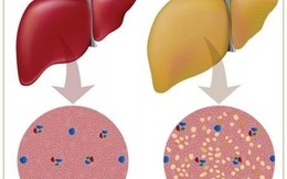 ​Đừng coi thường gan nhiễm mỡ