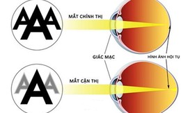 ​Tật khúc xạ học đường và cách phòng tránh