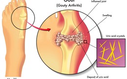 Chế độ ăn giúp giảm acid uric trong máu