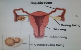 Bắt đền vì chẩn đoán viêm ruột thừa nhưng mổ thấy nang buồng trứng