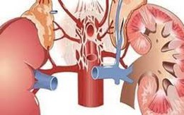 Lại suy thận cấp vì muốn tăng cường “chuyện ấy”