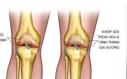​Bắt đầu cuộc sống không có viêm khớp ngay hôm nay
